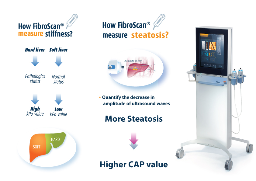 Echosens Fibroscan